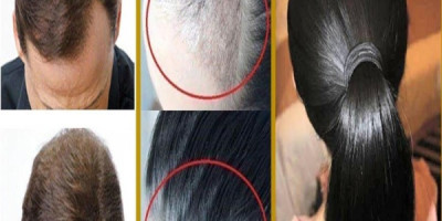 Treatment-And-Causes-Of-Excessive-Hair-Loss-At-Home