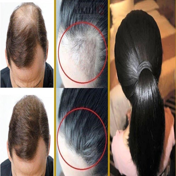 treatment-and-causes-of-excessive-hair-loss-at-home